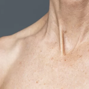 Image of Acne Treatments - Chest