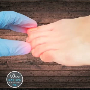 Get relief from painful ingrown nails with our professional treatment. Restore comfort and nail health at Pure Day Spa with expert care.