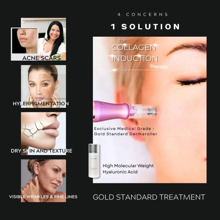 Medical-Grade-Microneedling-_-AnteAGE®-High-Molecular-Weight-Hyaluronic-Acid-in-Victoria-BC-Best-microneedling-promo-sale