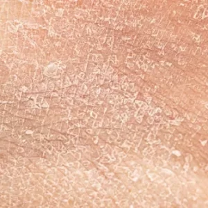 Understanding Dry Skin